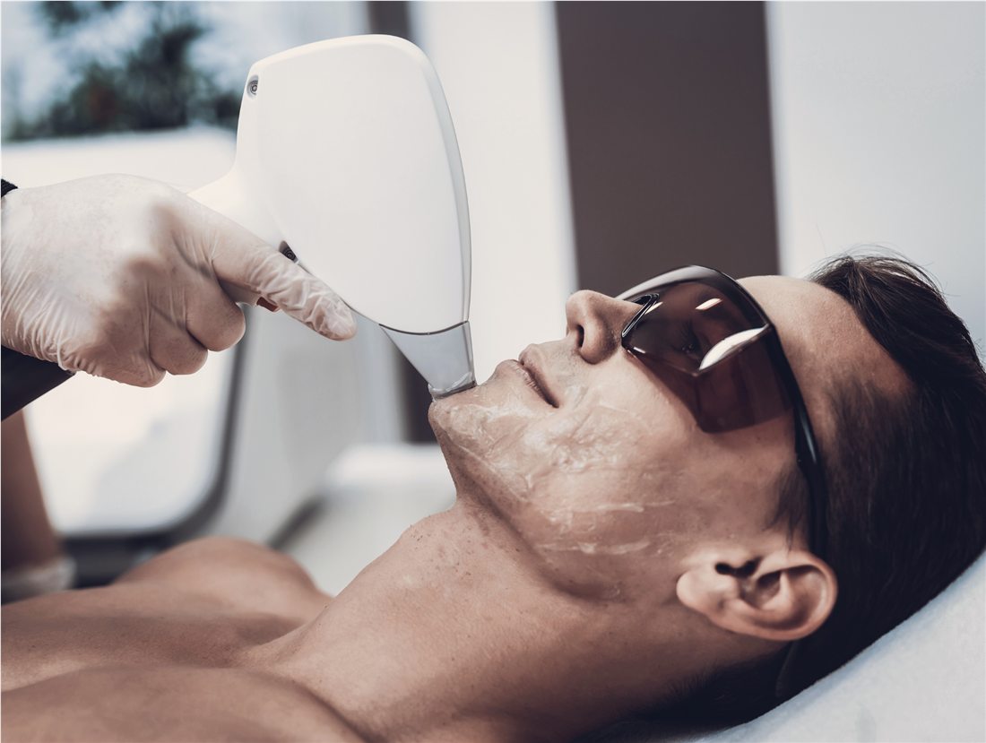 Laser hair removal for men