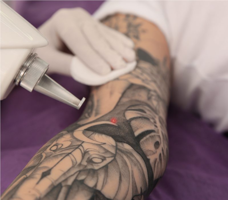 Tattoo removal